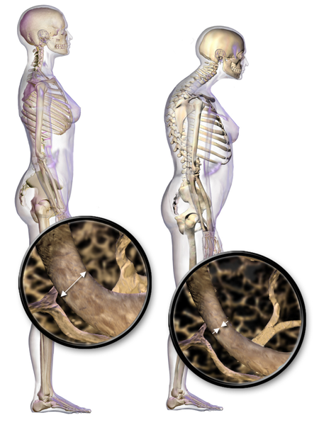 File:Blausen 0686 Osteoporosis 01.png