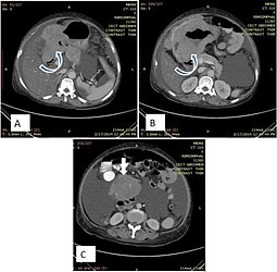 Fig. 20. Case of gastric lymphoma. A and B. Concentric wall thickening with homogenous contrast enhancement (curved arrows), involving the antrum and pylorus of the stomach without causing gastric outlet obstruction. C. Soft tissue mass encasing the mesenteric vessels without obstruction (white arrow).[1]