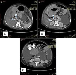 Fig. 20. Case of gastric lymphoma. A and B. Concentric wall thickening with homogenous contrast enhancement (curved arrows), involving the antrum and pylorus of the stomach without causing gastric outlet obstruction. C. Soft tissue mass encasing the mesenteric vessels without obstruction (white arrow).[2]