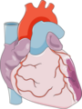 Myocardial infarction - Anterolateral infarct