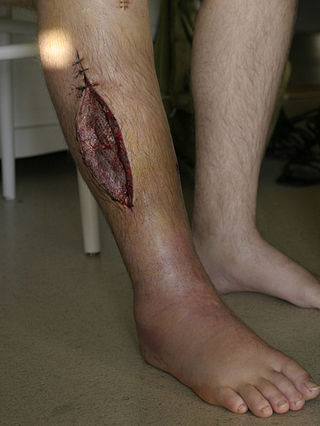 <span class="mw-page-title-main">Fasciotomy</span> Procedure used to treat compartment syndrome.