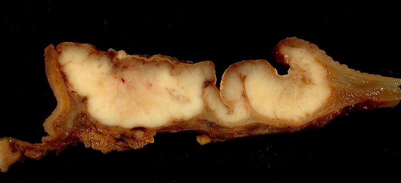 File:Gastric Adenocarcinoma.jpg