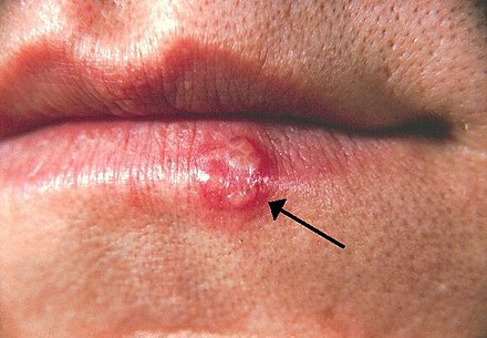 Oral herpes of the lower lip. Note the blisters in a group marked by an arrow.
