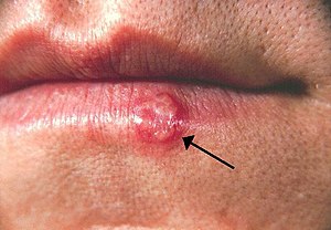 Herpes genital transmission 1 type Symptoms of