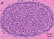 Histopathology of usual ductal hyperplasia.jpg