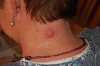 Inflamed epidermal inclusion cyst.jpg