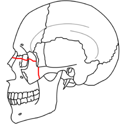 Le Fort III fractures