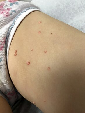 Round, hard, flesh colored bumps that are the symptom of Molluscum contagiosum virus infection.