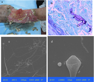 Mucormycosis