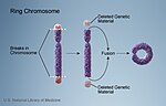 Thumbnail for Ring chromosome 14 syndrome