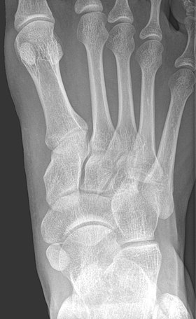 Radiografia piciorului care prezintă un os navicular accesoriu