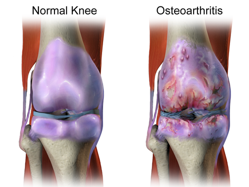 knee cartilage loss from knee arthritis