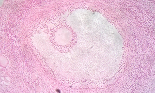 <span class="mw-page-title-main">Follicular atresia</span>