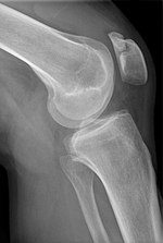 Thumbnail for File:Patella bipartita seitlich.jpg