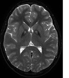 Die Neurodegeneration mit Eisenablagerung im Gehirn (obsolet: Hallervorden-Spatz-Syndrom, s. u.) 220px-Pkan-basal-ganglia-MRI