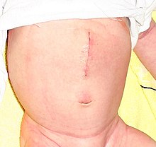 Vertical pyloromyotomy scar (large) 30 hrs post-op in a one-month-old baby Pyloromyotomie.jpg