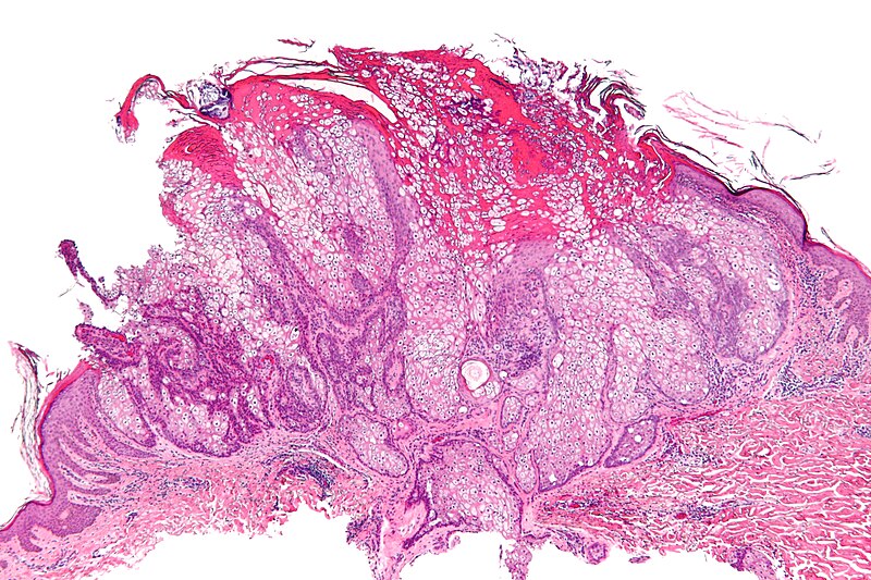 File:Sebaceous adenoma - low mag.jpg