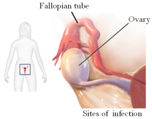 Sites of tubo ovarian abscess.PNG
