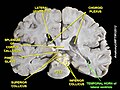 Ventricles Laterals