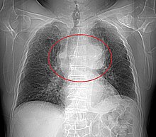 Radiographie thoracique montrant une masse volumineuse du médiastin antérieur débordant sur le poumon gauche et refoulant la trachée vers la droite.