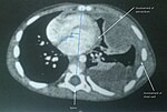 Thumbnail for Soft-tissue sarcoma