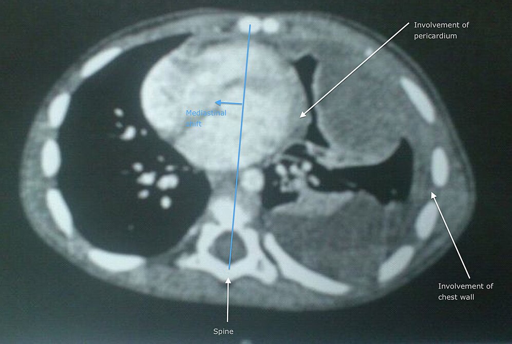 Soft-tissue Sarcoma-avatar