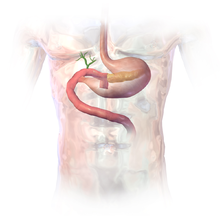 Pancreaticoduodenectomy Wikipedia