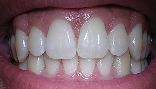 <span class="mw-page-title-main">Human tooth</span> Calcified whitish structure in humans mouths used to break down food