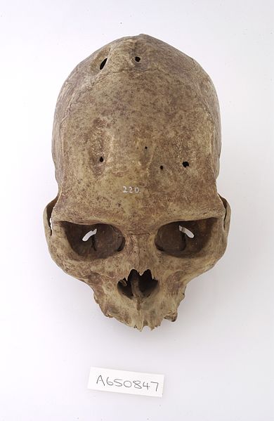 File:A human skull showing signs of Trepanning. Wellcome L0035690.jpg