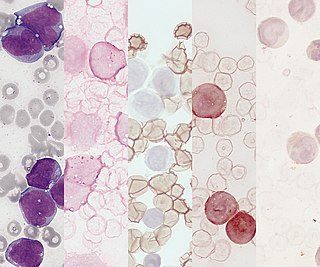 <span class="mw-page-title-main">Acute monocytic leukemia</span> Medical condition