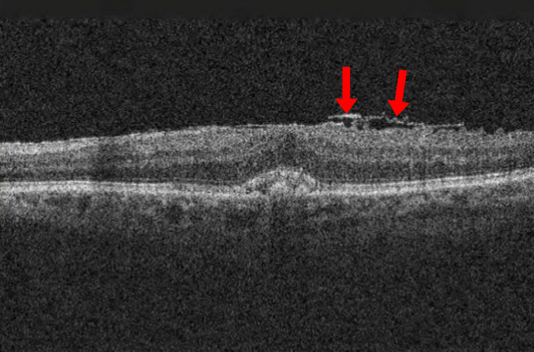 Membrana epiretinica