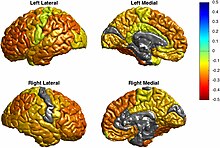 Cortical thinning in adult bipolar Mp201773f1.jpg