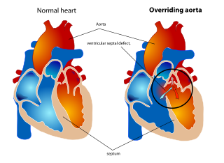 Overriding aorta Medical condition