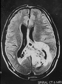 Chap temporal va parieto-oksipital hududlarni o'z ichiga olgan giper-intensiv lezyonni ko'rsatadigan kontrastli bo'lmagan magnit-rezonans tomografiya. Shish o'rta chiziqdan o'ng parietal mintaqaga o'tmoqda.