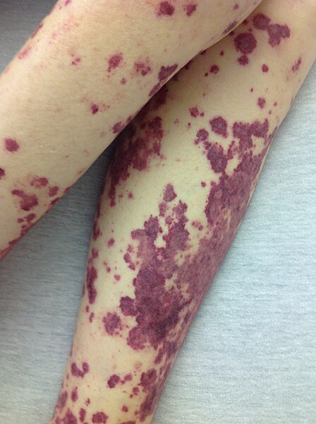 File:Petechial rash.JPG