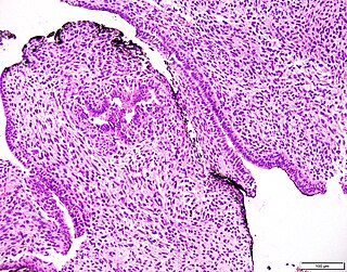Prostatic stromal tumour of uncertain malignant potential