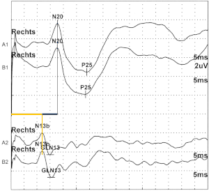 Evozierte Potentiale Doccheck