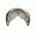 Left and right parietal bone.