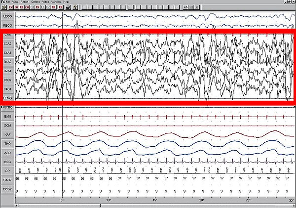 Polysomnogram demonstrating slow-wave sleep. High amplitude EEG is highlighted in red.