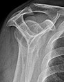 File:Subacromial space on outlet view 0 - Wikipedia