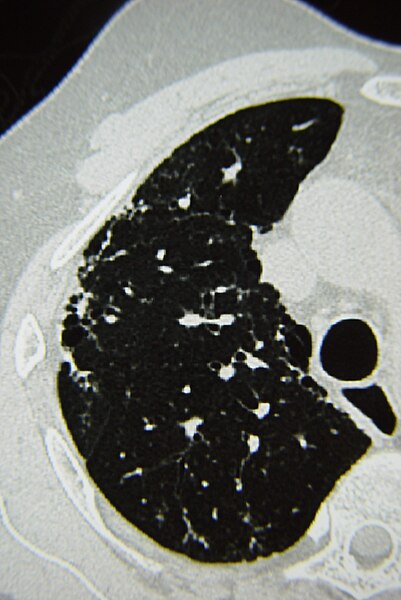 File:Systemic sclerosis case 32 pic 06.jpg