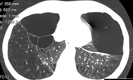 Computed tomography of the lung showing emphysema and bullae in the lower lung lobes of a subject with type ZZ alpha-1-antitrypsin deficiency. There is also increased lung density in areas with compression of lung tissue by the bullae. Alpha 1-antitrypsine deficiency lung CT scan.JPEG