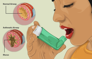 An Asthma patient taking medication using an inhaler.png