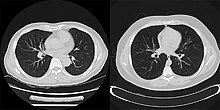 CT scan using iterative reconstruction (left) versus filtered backprojection (right) CT scan Iterative reconstruction (left) versus filtered backprojection (right).jpg