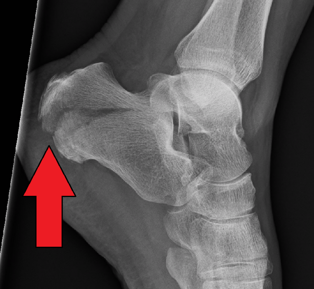Calcaneal fracture - Wikipedia