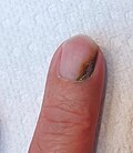 Thumbnail for Green nail syndrome