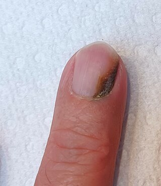 <span class="mw-page-title-main">Green nail syndrome</span> Medical condition