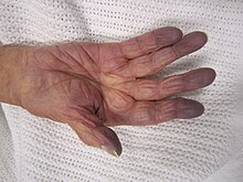 Egy fehér ember keze egy lapra kerül, a tenyere látható.  A kéz és a csukló normál rózsaszínű, míg az ujjak sötétkék árnyalattal rendelkeznek.