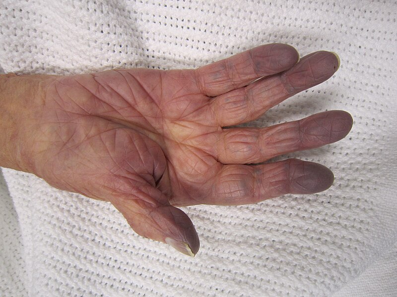 peripheral cyanosis vs central cyanosis