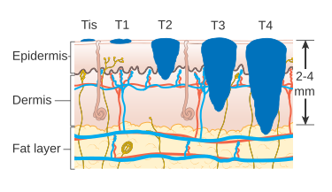 Diagram showing the T stages of melanoma CRUK 373